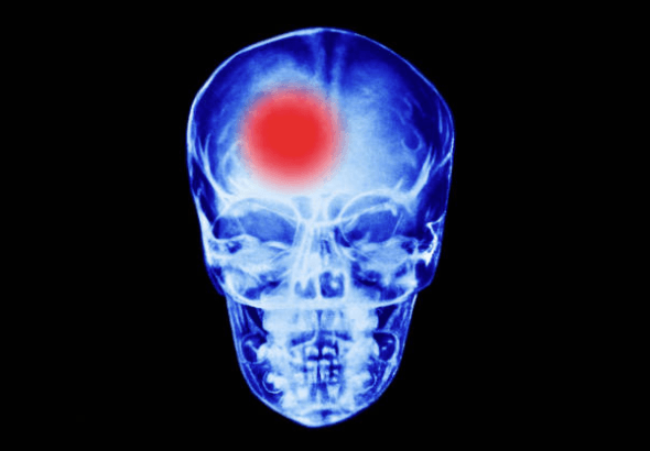 Why Stroke Recovery Depends Heavily on How Fast the Right Brain Hospital Takes Over